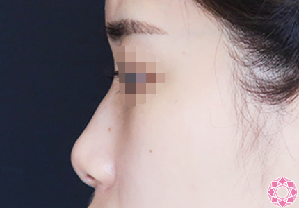 年代：20代 施術名：プチ隆鼻術（ヒアルロン酸） 施術前｜【公式】東京形成美容外科