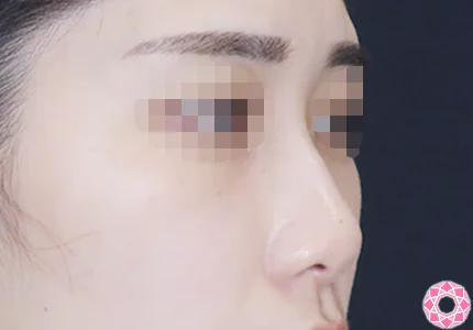 年代：20代 施術名：プチ隆鼻術（ヒアルロン酸） 施術前｜【公式】東京形成美容外科