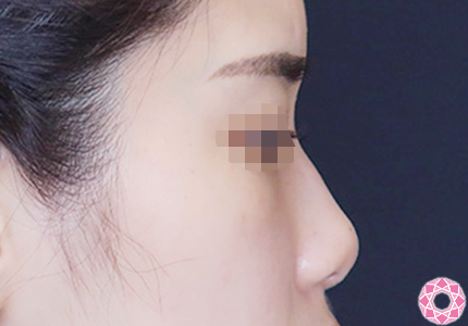 年代：20代 施術名：プチ隆鼻術（ヒアルロン酸） 施術前｜【公式】東京形成美容外科