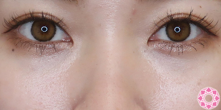 年代：20代 施術名：目の下のふくらみ取り 施術後｜【公式】東京形成美容外科