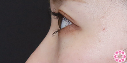 年代：20代 施術名：目の下のふくらみ取り 施術後｜【公式】東京形成美容外科