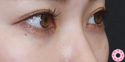 年代：20代 施術名：目の下のふくらみ取り 施術後｜【公式】東京形成美容外科