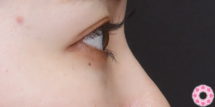 年代：20代 施術名：目の下のふくらみ取り 施術後｜【公式】東京形成美容外科