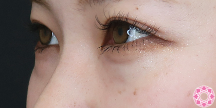 年代：20代 施術名：目の下のふくらみ取り 施術前｜【公式】東京形成美容外科