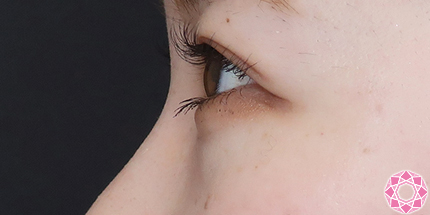 年代：20代 施術名：目の下のふくらみ取り 施術前｜【公式】東京形成美容外科