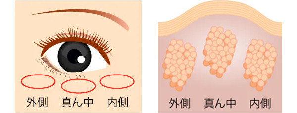 眼窩脂肪のイラスト