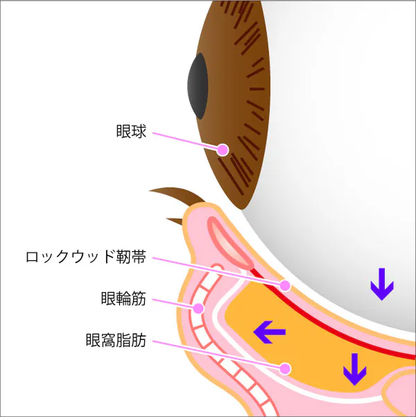 目の下のふくらみの仕組みを表すイラスト