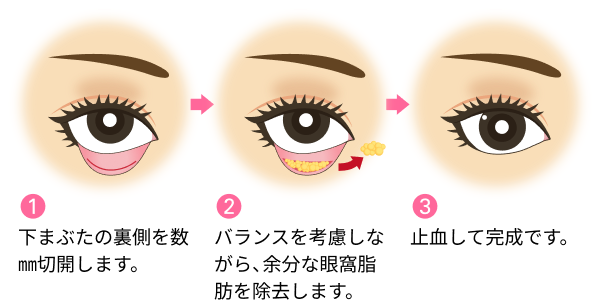 目の下の切らないクマ取り・ふくらみ取りの施術方法のイラスト