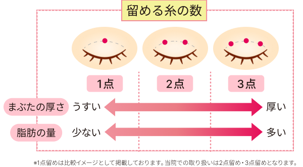 二重埋没法